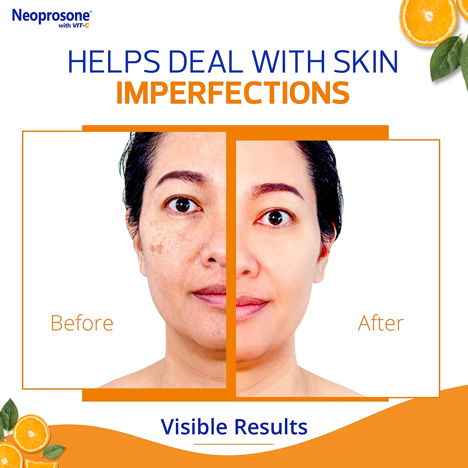 Neoprosone 20% Vitamin C Dark Spot Cream 30ml Mitchell Brands - Mitchell Brands - Skin Lightening, Skin Brightening, Fade Dark Spots, Shea Butter, Hair Growth Products